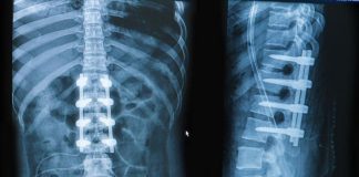 Bone Growth Stimulators Market to Record Ascending Growth by 2026| Apple, Google, Microsoft, Amazon Web Services, Dropbox, Egnyte, Copy, SpiderOak, Box, Buffalo Bone Growth Stimulators Market - Premium Market Insights